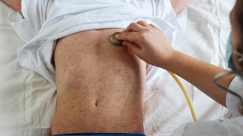 Salud detecta dos casos de sarampión en Navarra